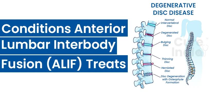 Conditions Treated by ALIF Surgery in India